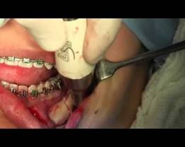 CMF - Orthognathic Surgery Left side, Dr Colucci