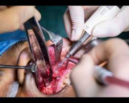 CMF surgery LeFort I - Dr Jahrad HAQ - London, UK