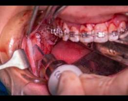CMF surgery LeFort I, BSSO & Genioplasty - Dr Jahrad HAQ - London, UK