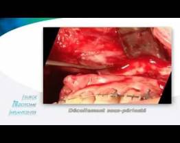 CMF -  Orthognathic Surgery, Dr Solyom